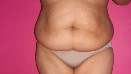 Cómo acceder al Bono PAD para abdominoplastía y reconstrucción mamaria Cómo acceder al Bono PAD para abdominoplastía y reconstrucción mamaria