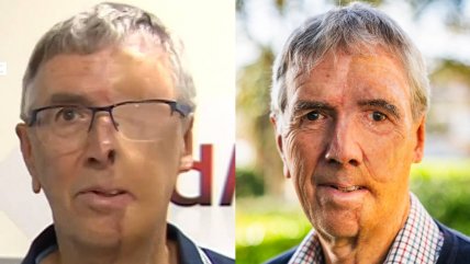   Hombre reconstruye su rostro tras accidente gracias a prótesis 3D 